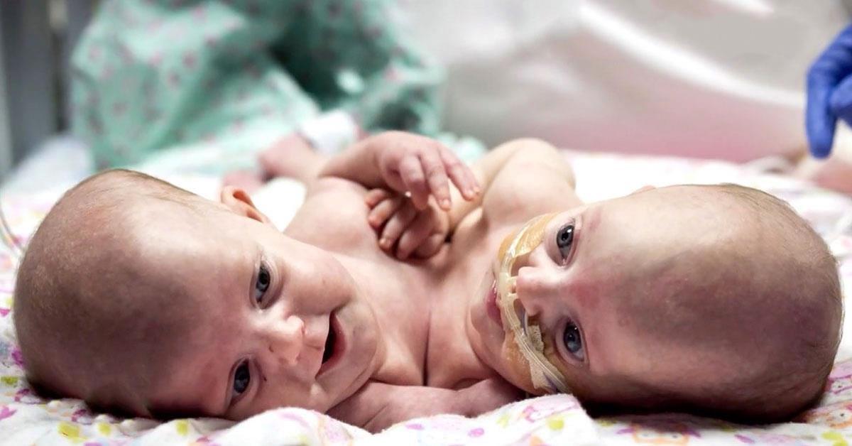Praise God: Twins Conjoined At The Torso Successfully Separated After 7