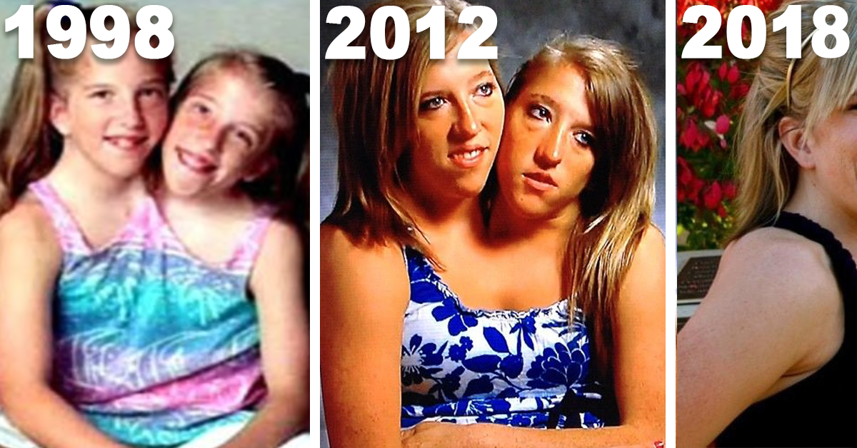 What Conjoined Twins Abby And Brittany Hensel Look Like Today Jesus Daily