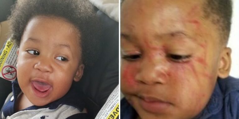 Boy-Attacked-at-Daycare