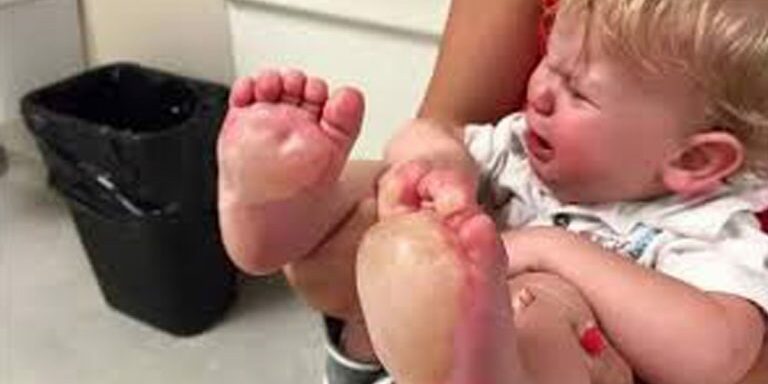 babyburned2