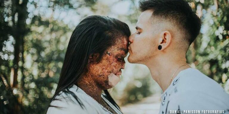 man-of-god-engaged-to-woman-diagnosed-with-incurable-skin-disease-and-inspires-millions-1