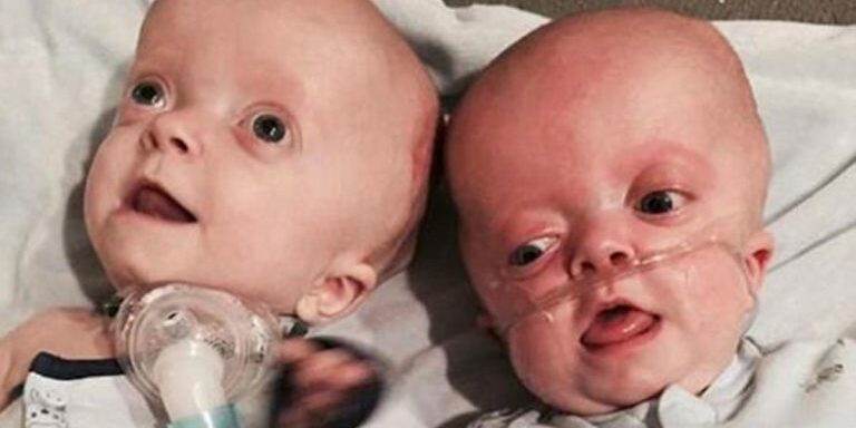nurse_adopts_kids_pfeiffer_syndrome_featured