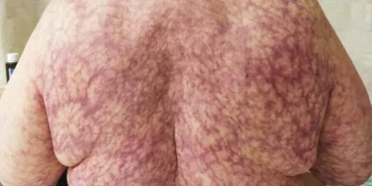 skin4