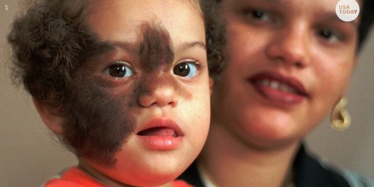 syndrome2