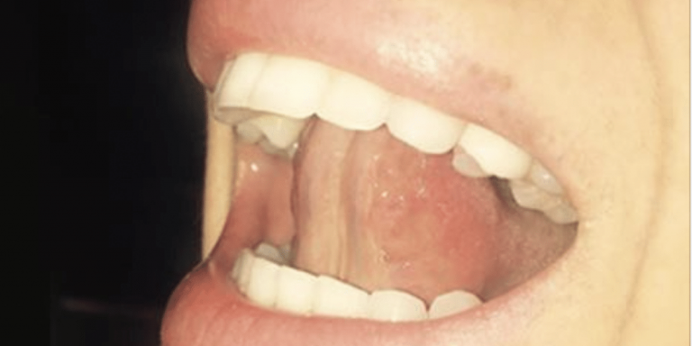 tongue12