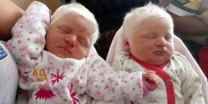 twins-snow-white-hair-696x364